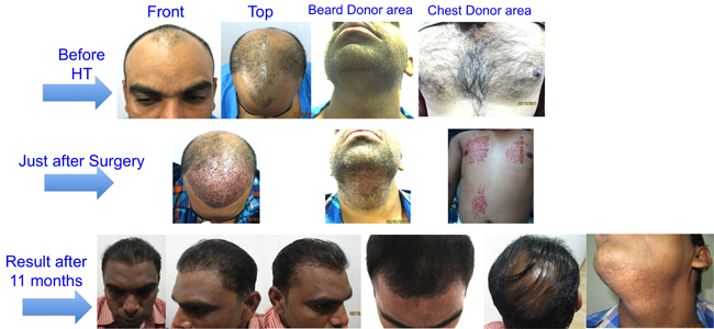 Dr. Bishan Mahadevia's - Hair Transplant Clinic India, Hair Surgery India,  Hair Doctor India - Goodbyehairloss