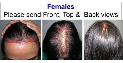Free Hair Loss Consultation Online - Baldness | Hair Growth | Hair  Restoration | FUE  Mahadevia - Goodbyehairloss