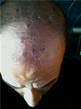 Dr Bishan Mahadevia S Hair Transplant Clinic India Hair